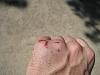 boxers fracture??-img_0257.jpg